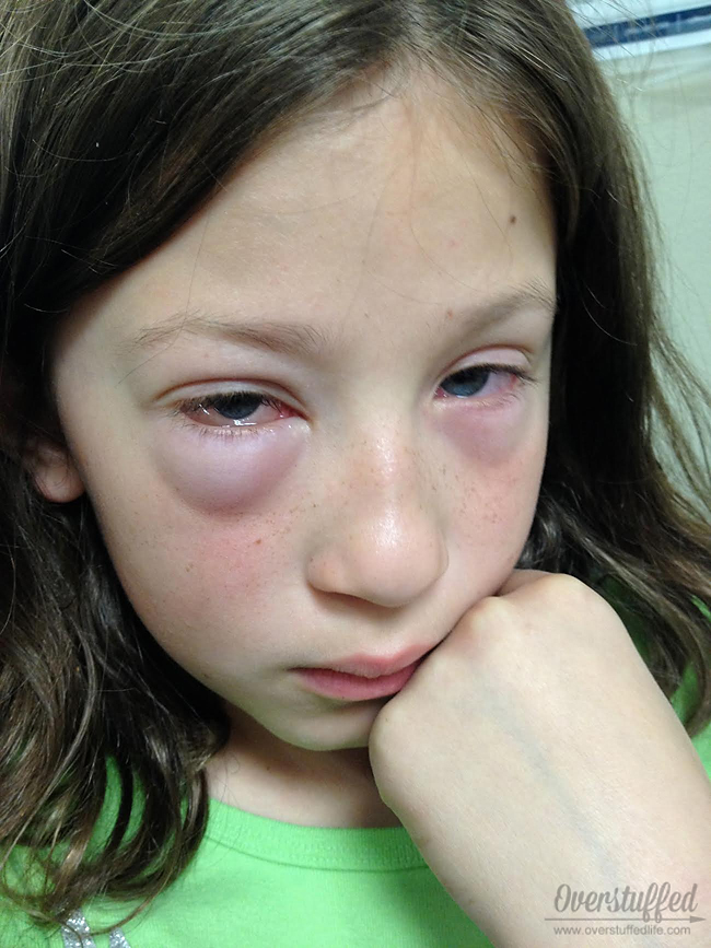 6 Ways to Help Kids Beat Seasonal Allergies